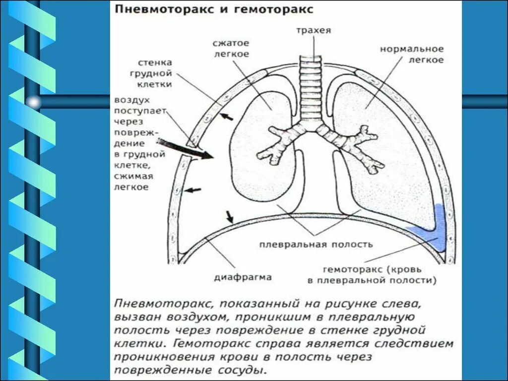 Попадание воздуха в полость. Повреждения грудной клетки пневмоторакс. Ранение в грудную клетку пневмоторакс. Пневмоторакс при ранении грудной клетки. Пневмоторакс схема.