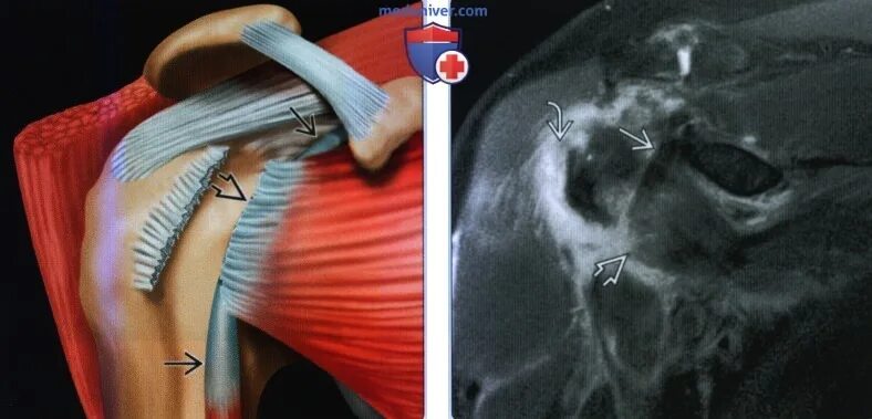 Повреждение сухожилия подлопаточной мышцы. Тенолиз сухожилия подлопаточной мышцы. Теносиновит плечевого сухожилия. Тендинит двуглавой мышцы. Сухожилие надостной мышцы мрт.