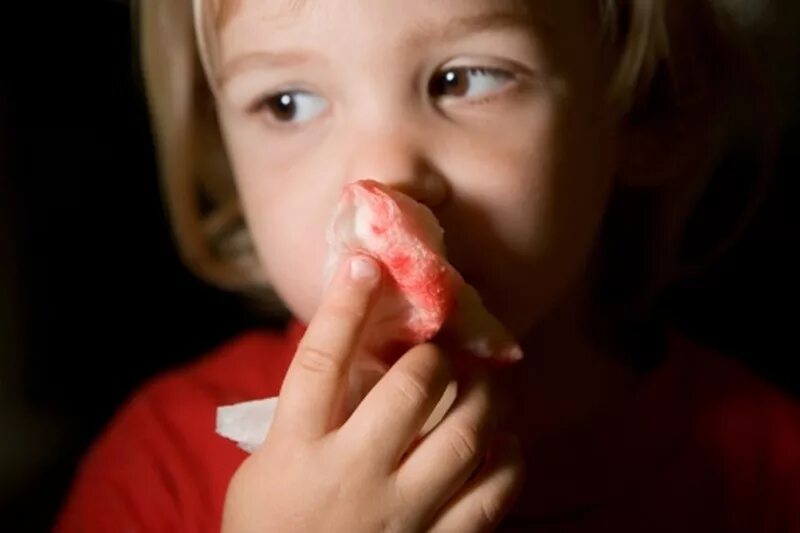 Носовое кровотечение из носа. Носовое кровотечение у детей. Носовоекровотечениеудетец. Нлсовоеткровоьечение у детей.