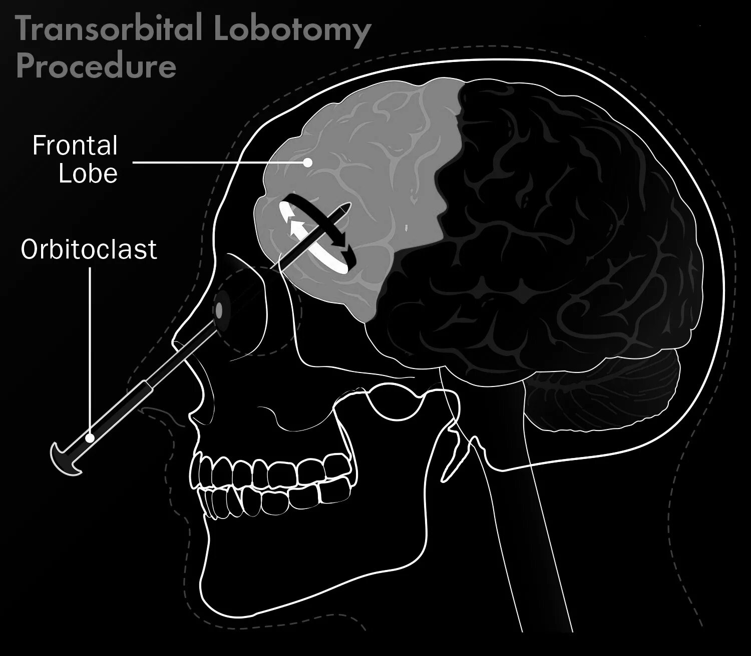 Лоботомия для чего нужна. Префронтальная Лоботомия. Орбитокласт Лоботомия.