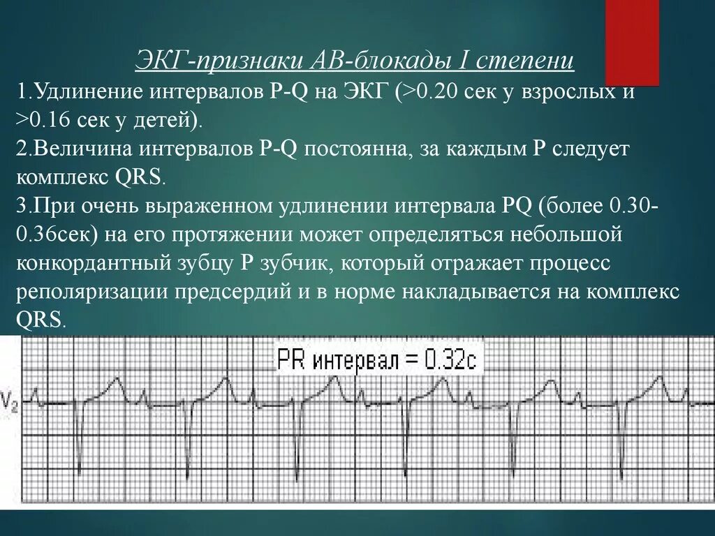 Что значит полная блокада. Признаки АВ блокады 1 степени. Признаки АВ блокады 1 степени на ЭКГ. АВ блокада 1 степени на ЭКГ. ЭКГ критерии АВ блокады 1 степени.