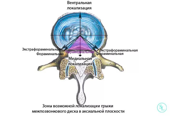 Грыжа диска позвоночника l5 s1. Грыжа /экструзия диска l4-l5 l5 l4. Медианно-парамедианная грыжа диска l5-s1. Медианная грыжа межпозвонкового диска l5-s1.