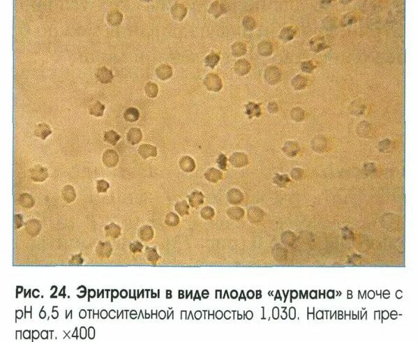 Эритроциты выщелоченные микроскопия. Песок в моче. Эритроциты в моче. Коричневый песок в моче. Появление эритроцитов в моче