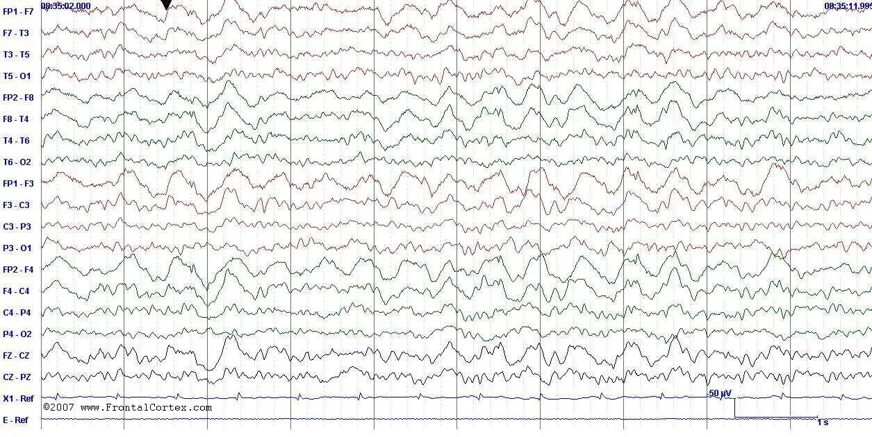 Ээг детям для чего назначают. Паттерн Firda на ЭЭГ. ЭЭГ при ДЦП. Фирда волны на ЭЭГ. ЭЭГ ребенка с ДЦП заключения.