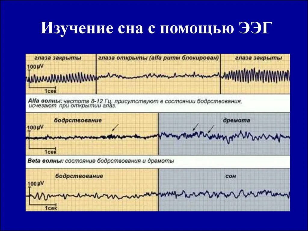 Альфа ритм ЭЭГ. ЭЭГ бодрствования. ЭЭГ Альфа бета тета Дельта ритмы. ЭЭГ сна и бодрствования.