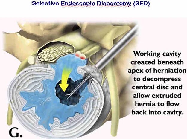 Лазерная вапоризация диска. Лазерная вапоризация диска. Лазерная вапоризация межпозвонковой грыжи. Лазерная вапоризация межпозвонкового диска. Лазерная операция грыжи позвоночника.