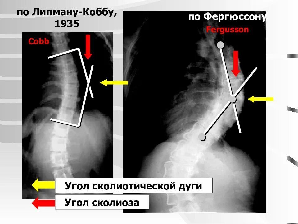 Сколиоз позвоночника рентген степени. Рентген сколиоз угол Кобба. Угол сколиоза по чаклину рентген. Измерение угла сколиоза по чаклину. Угол кобба