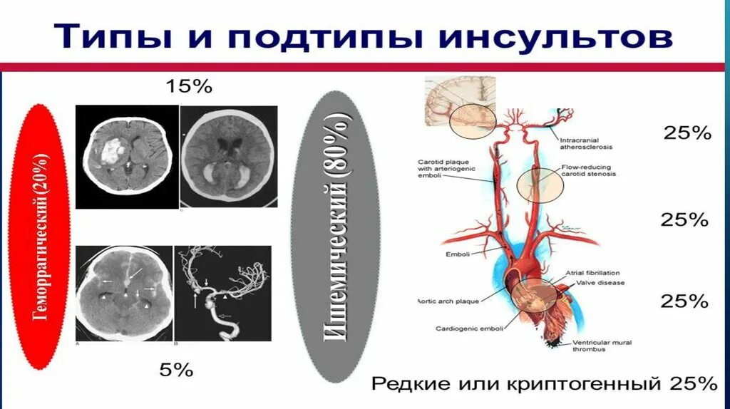 Криптогенный инсульт. Классификация инсультов. Геморрагический инсульт классификация. Подтипы ишемического инсульта. Подтипы инсультов криптогенный.