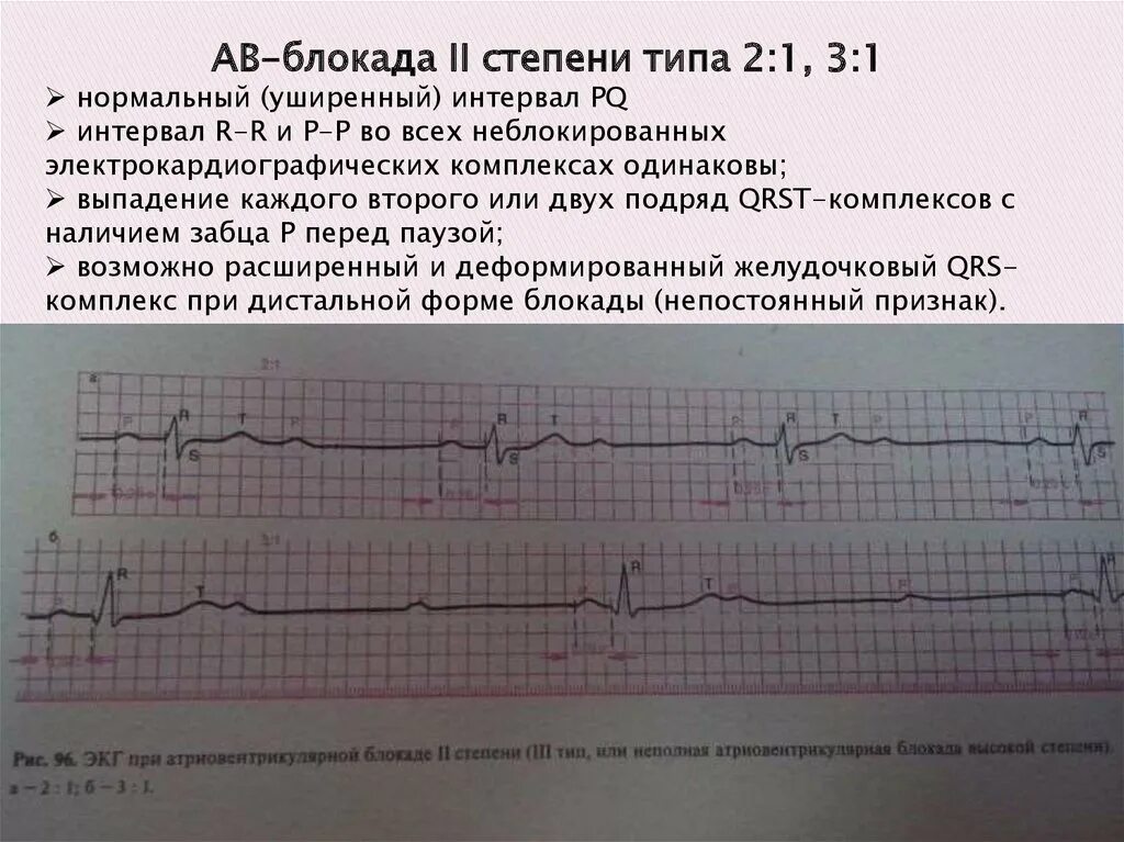 Комплекс блокада. АВ блокада 2 степени 1 типа 3:1. Синоатриальная блокада Мобитц 1 ЭКГ. Синоатриальная блокада 2 степени на ЭКГ. АВ блокада 2 степени с выпадением QRS.