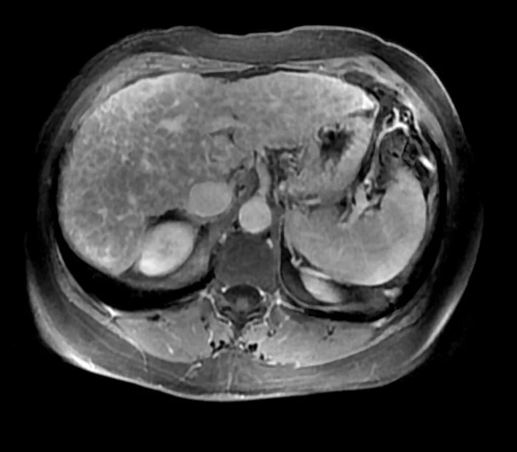Хронический гепатит кт. Фиброламеллярная карцинома печени мрт. Гемохроматоз печени мрт. Образования печени мрт. Аденома печени кт признаки.