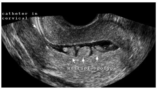 Эндометрия матки УЗИ гиперплазия эндометрия. УЗИ картина полипа эндометрия. Полип эндометрия на УЗИ малого таза. Полипы эндометрия снимок УЗИ. Гиперплазия полости матки