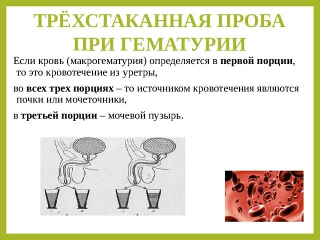 Трехстаканная проба. Гематурия трехстаканная проба. Трёхстаканная проба при гематурии. Трехстаканная проба мочи