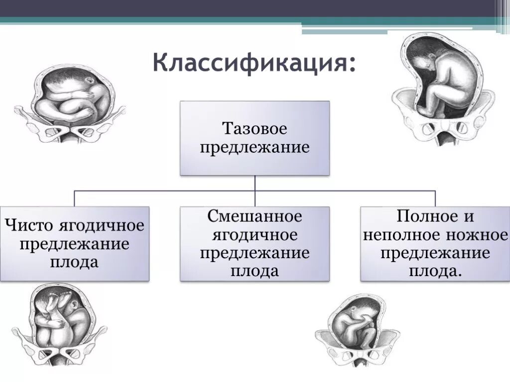 Осложнения тазового предлежания. Предлежание плода классификация. Тазовое предлежание плода классификация. Ягодичное предлежание плода классификация. Классификация тазовых предлежаний.