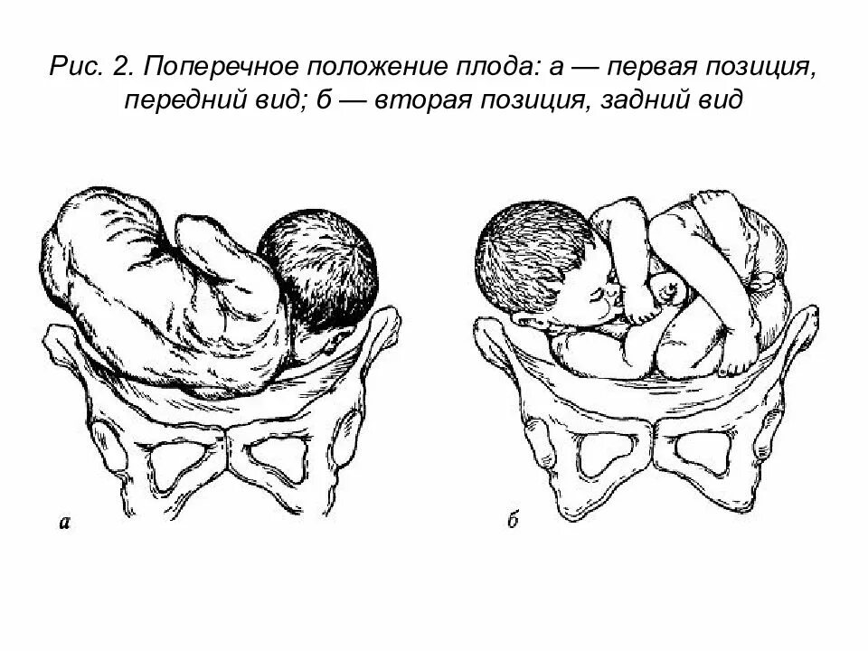 Позиция плода в акушерстве. Тазовое предлежание плода 2 позиция. Продольное головное предлежание 2 позиция. Тазовое предлежание 2 позиция задний вид. Тазовое предлежание плода 2 позиция передний вид.