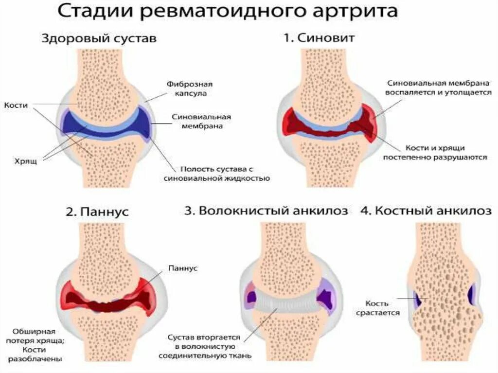 Ревматоидный артрит клинические рекомендации 2020. Суставные формы ювенильного ревматоидного артрита. Кожные симптомы ревматоидного артрита. Юнивиальный ревматоидный артрит. Изменение формы сустава