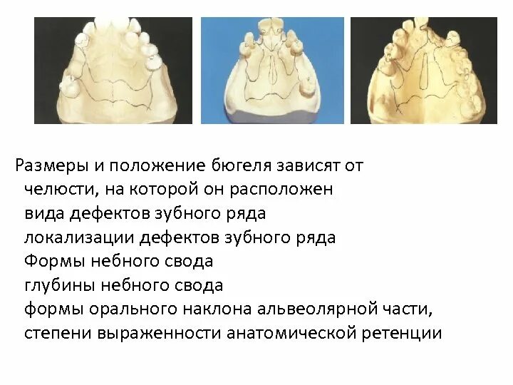 Планирование конструкции бюгельного протеза. Нанесение рисунка каркаса бюгельного протеза на модель.