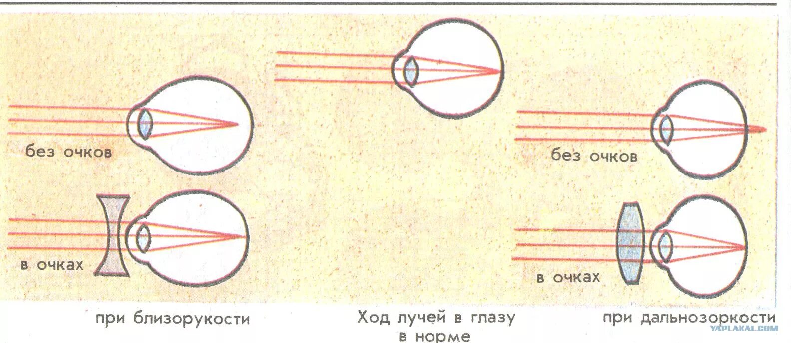 Ход лучей глаза человека. Дальнозоркость и близорукость строение глаза. Близорукость и дальнозоркость схема глаза. Очки ( схемы : близорукость и дальнозоркость). Оптическая схема коррекции близорукости/дальнозоркости.