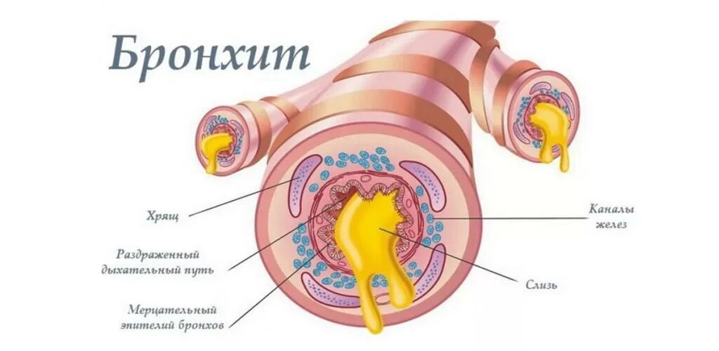 Средний бронхит. Бронзитит.