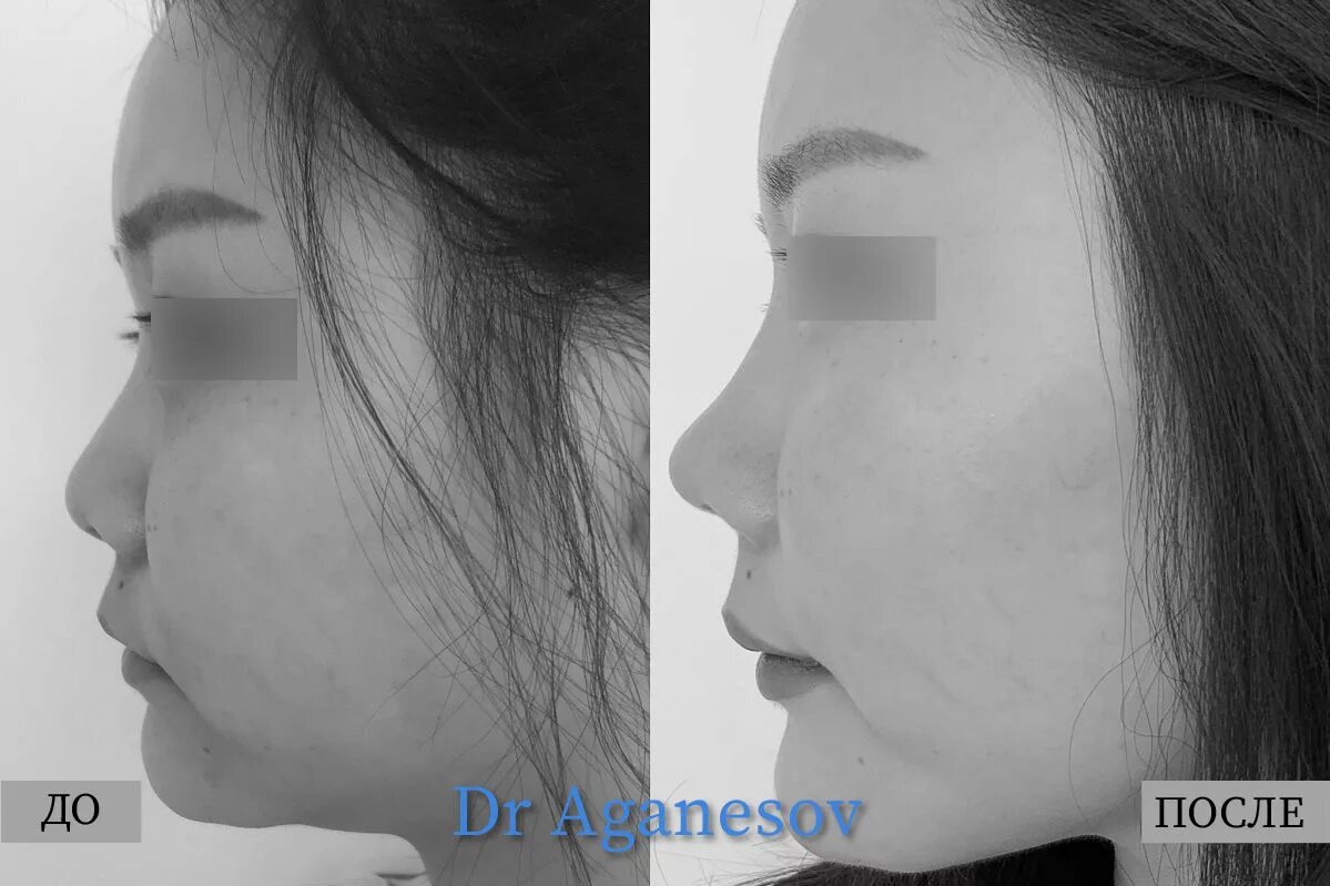 тео ринопластика. ринопластика носа спинка носа. тео ринопластика. григорянц ринопластика до и после. ринопластика спинка носа.