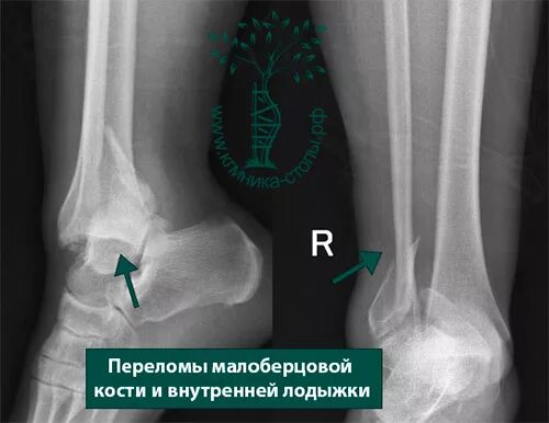 Перелом малоберцовой кости клиника. Малоберцовая кость перелом голеностопа. Перелом правой малоберцовой кости. Перелом основания малоберцовой кости. Перелом н 3