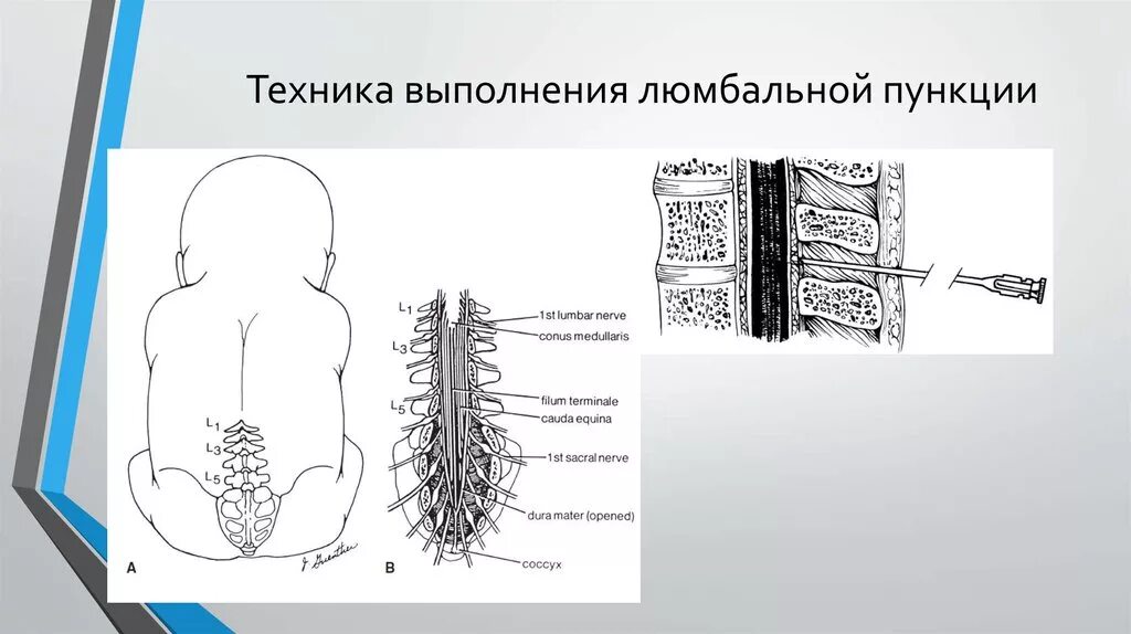 Спинномозговая пункция алгоритм. Пункция спинного мозга техника. люмбальная пункция показания техника. техника выполнения спинномозговой пункции. спинномозговая пункция схема.