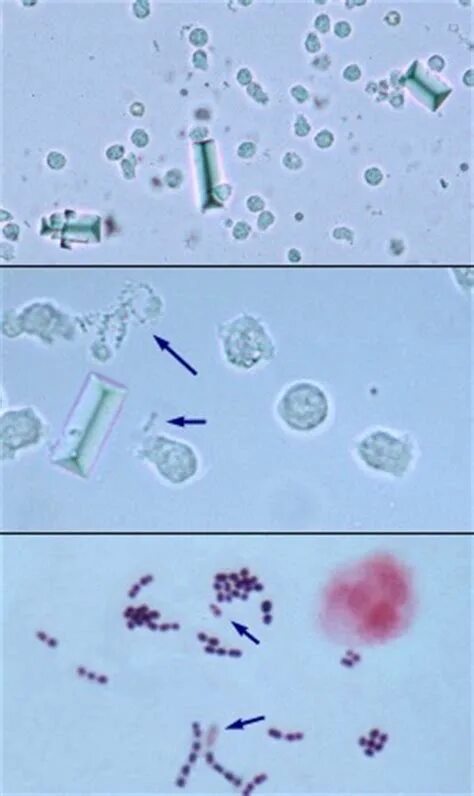 Струвиты микроскопия. Бактерии в моче микроскопия. Микроскопия мочи палочки. Кокки в моче микроскопия.