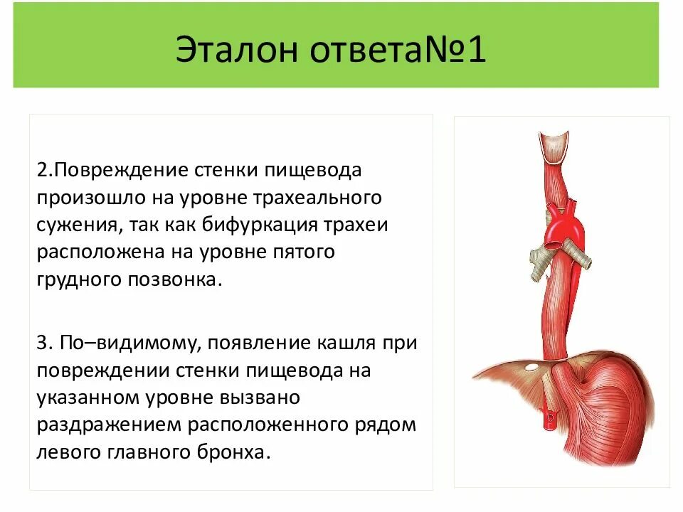 Анатомические сужения пищевода. Сужение пищевода на уровне 5 грудного позвонка. Ситуационные задачи по пищеварительной системе.