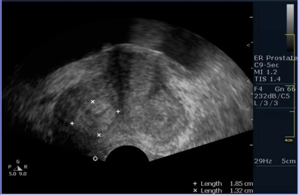Узел в простате. Трансректальное УЗИ предстательной железы. УЗИ трузи предстательной железы. Трансабдоминальное УЗИ предстательной железы. ДГПЖ на УЗИ предстательной железы.