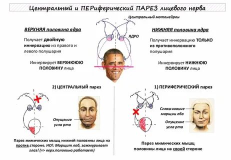 Центральный парез