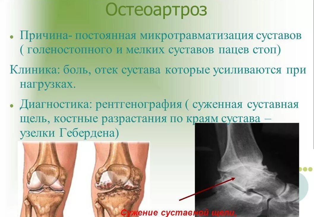 Артроз голеностопного сустава 2 степени рентген. Остеоартроз голеностопа 1-2 степени. Рентген деформирующий артроз голеностопного сустава сустава. Полиостеоартроз голеностопного сустава. Отеки при артрозе коленного сустава