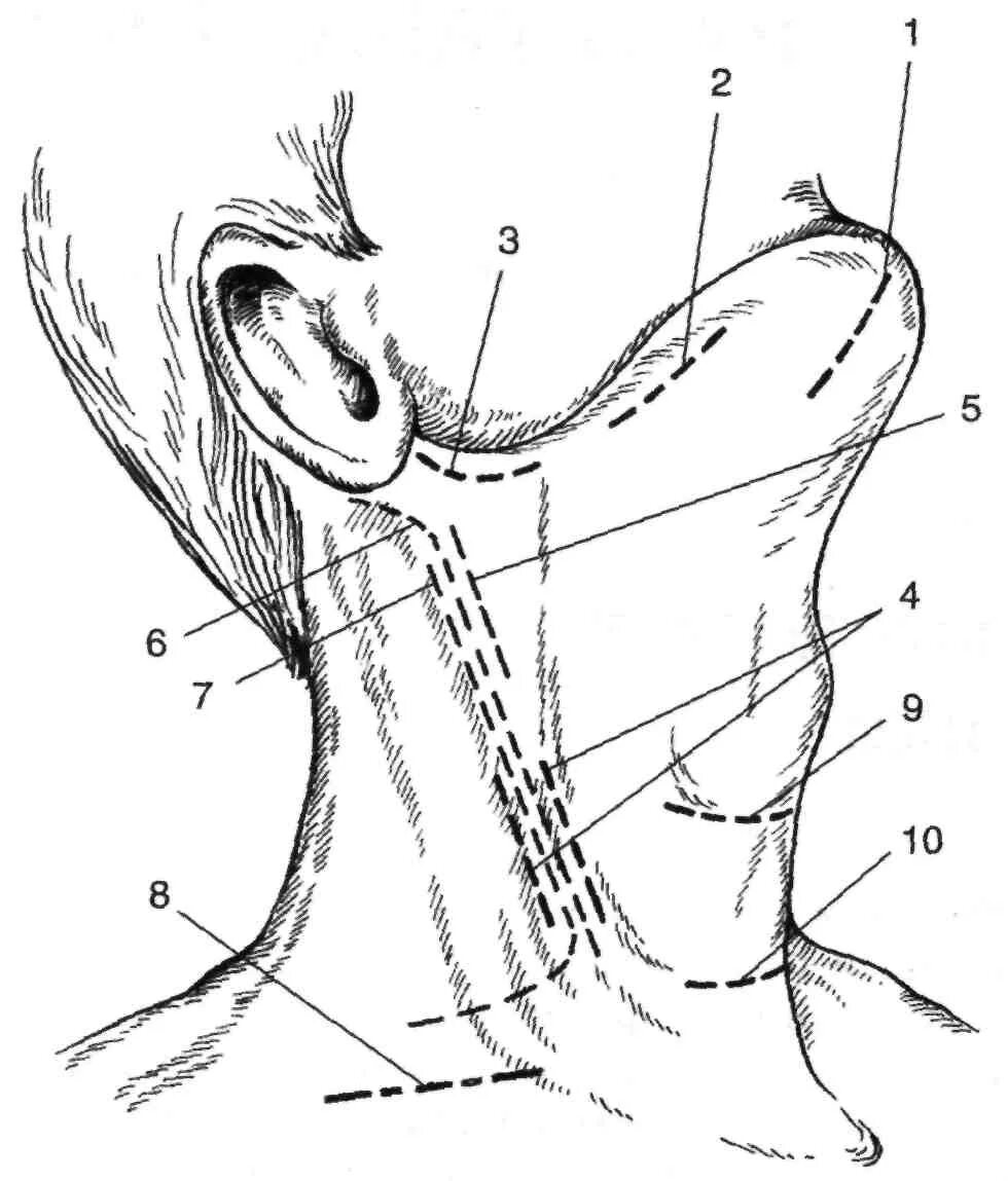 Флегмоны шеи топографическая анатомия. Топография абсцессов шеи. Доступы для вскрытия флегмон шеи. Хирургическая анатомия разрезов при гнойных процессах шеи..