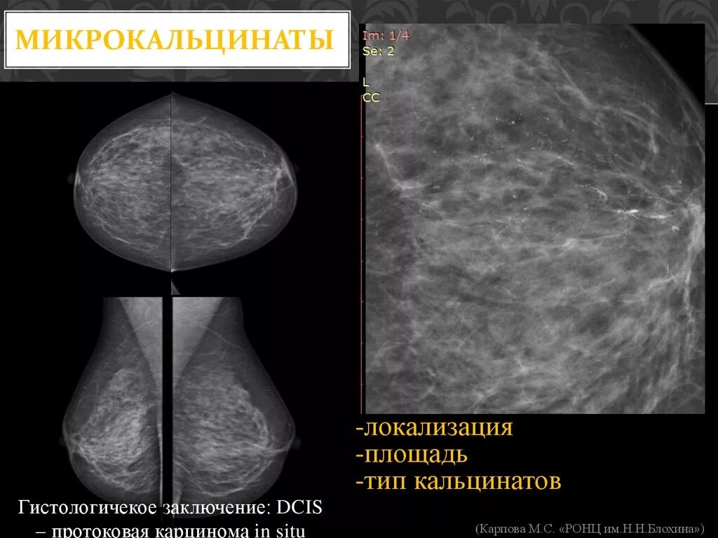 Округлые кальцинаты. Аморфные микрокальцинаты. Линейные кальцинаты маммография. Кальцинаты молочной железы на маммографии. Маммография микрокальцинаты.