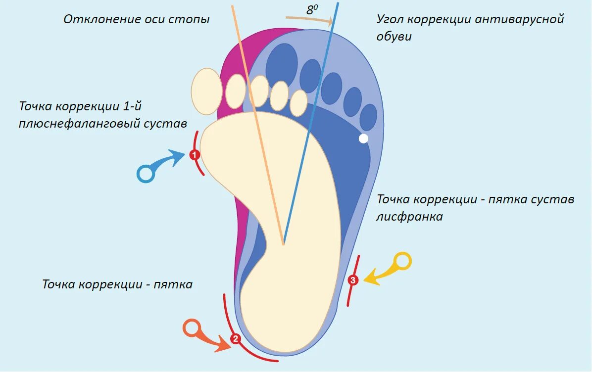 Обувь деформация стопы. Антиварусная обувь стелька. обувь для варусной стопы. антиварусная стелька для детей. стельки при косолапости.