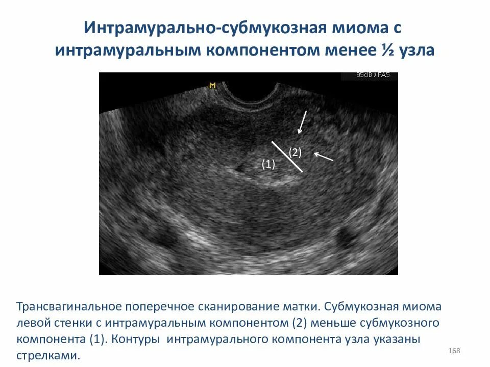 Полость матки деформирована. Миома матки классификация УЗИ. УЗИ миома матки субсерозный узел. Интрамуральная миома матки УЗИ.