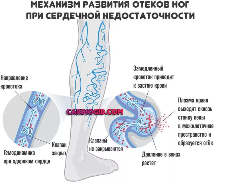 Степени отечности