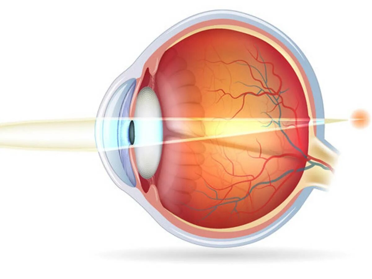 Дальнозоркость или гиперметропия. Дальнозоркость сетчатка. Рефракционная амблиопия. Причины дальнозоркости кратко. Дальнозоркость развивается при.