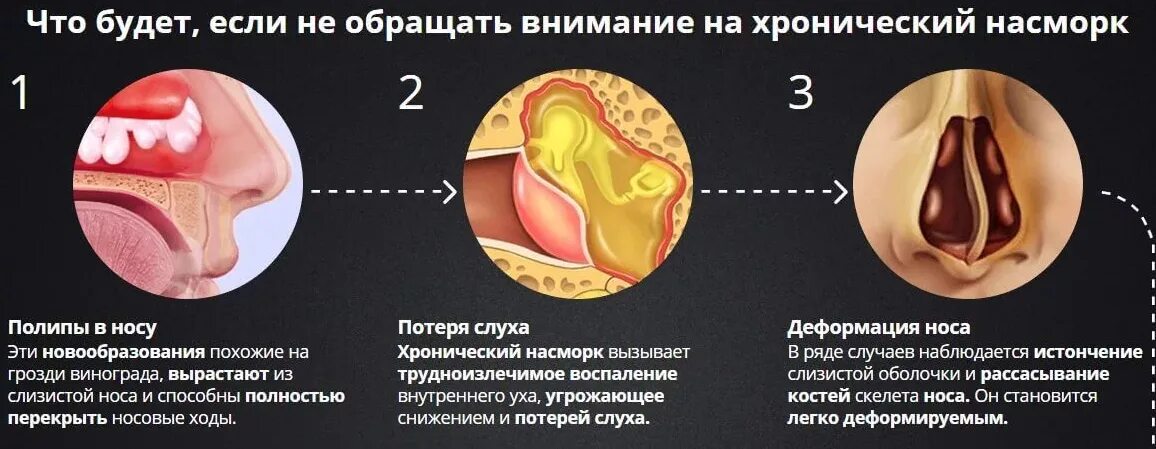 Затяжное заложенность носа. Носовые раковины при аллергическом рините. Хронический насморк причины.