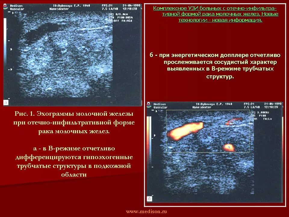 УЗИ при фиброаденоме молочной железы. Жировая долька молочной железы ультразвуковое исследование. Жировые включения в молочной железе на УЗИ. Злокачественное образование молочной железы на УЗИ.