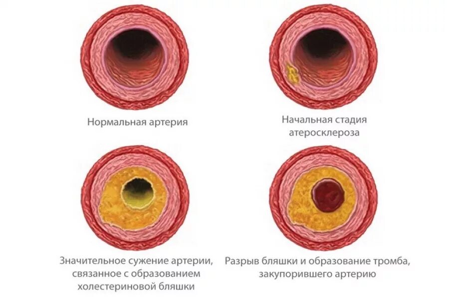 Сужение сосудов симптомы причины. Атеросклеротические бляшки в сосудах образуются. Кальцинированная атеросклеротическая бляшка. Атеросклеротические бляшки формируются в. Атеросклероз холестериновая бляшка.