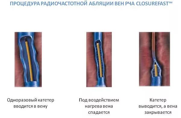 Абляция пищевода. Эндовазальная радиочастотная абляция. Радиочастотная облитерация (РЧО) вен нижних конечностей. Радиочастотная коагуляция вен нижних конечностей.