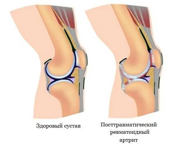 Выпот в полости коленного сустава. Ревматоидный гонартроз коленного сустава. Посттравматический остеоартрит коленного сустава. Воспаление посттравматическое в коленном суставе. Посттравматический ревматоидный артрит коленный сустав.