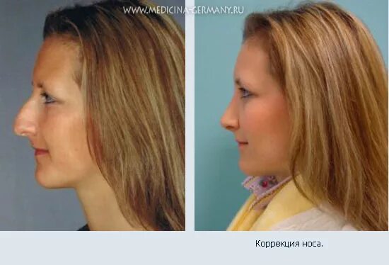 ринопластика лангет