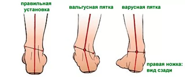 Пятки внутрь. Плоскостопие вальгусная стопа. Плоско варусная деформация стопы. Варус и вальгус стопы отличие. Вальгус деформация стопы.