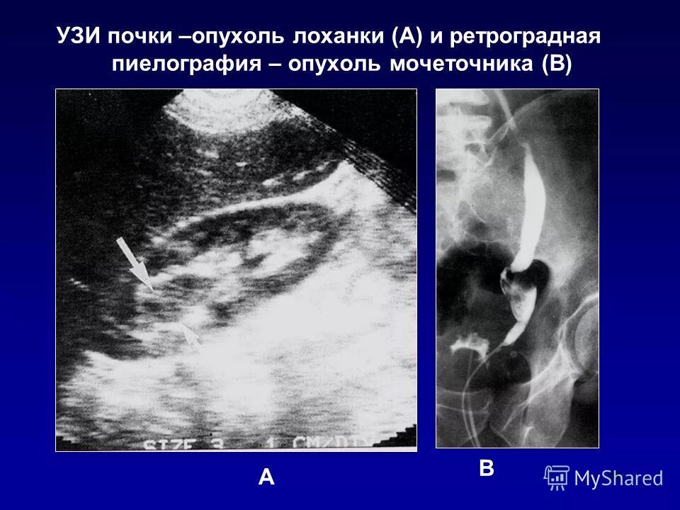 Опухоль почечной лоханки кт. Опухоль лоханки почки кт. Опухоль лоханки почки УЗИ.