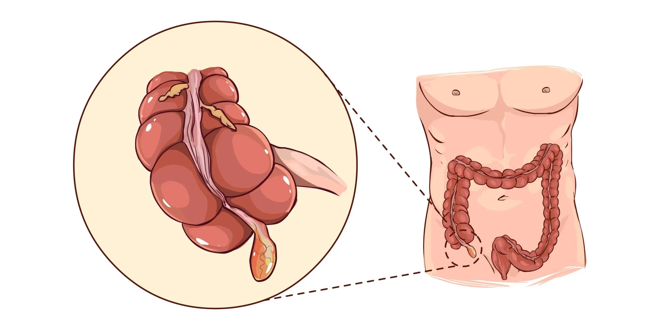 Червеобразный отросток аппендикс. Острый аппендицит орган. Червеобразный аппендицит. Боль в слепой кишке