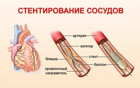 Инфаркт миокарда стентирование жизнь после