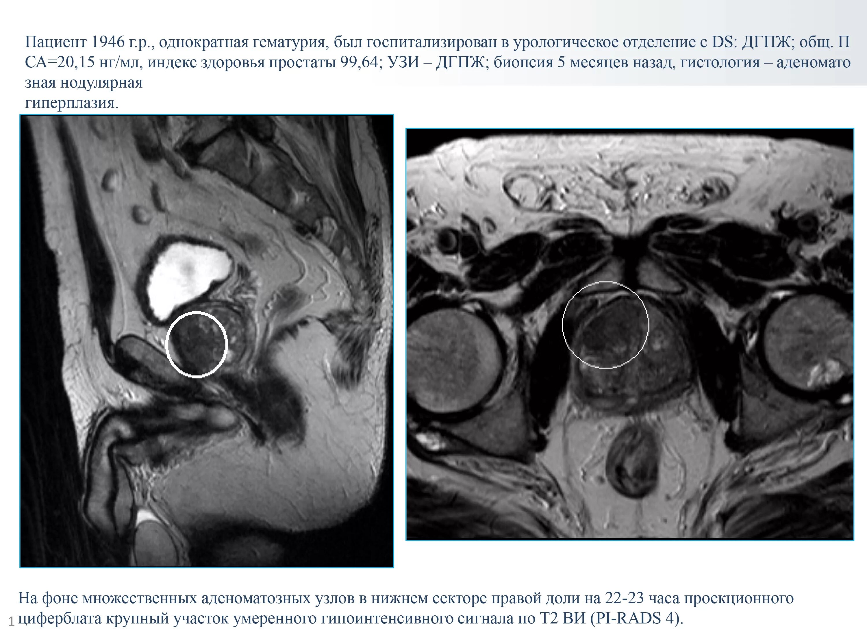 Карцинома мрт предстательной железы. Аденокарцинома предстательной железы мрт. Гиперплазия предстательной железы мрт. Аденома предстательной на мрт. Аденома простаты мрт