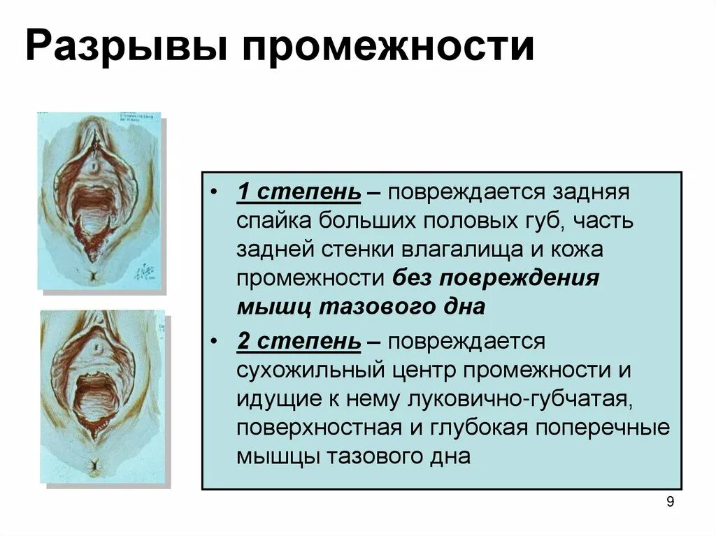 Центральный разрыв промежности. Разрыв промежности в родах. Разрыв промежности 1 степени при родах. Половые органы рожавшей.