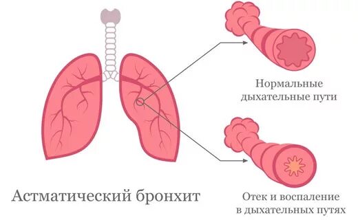 Астматический бронхит симптомы и лечение