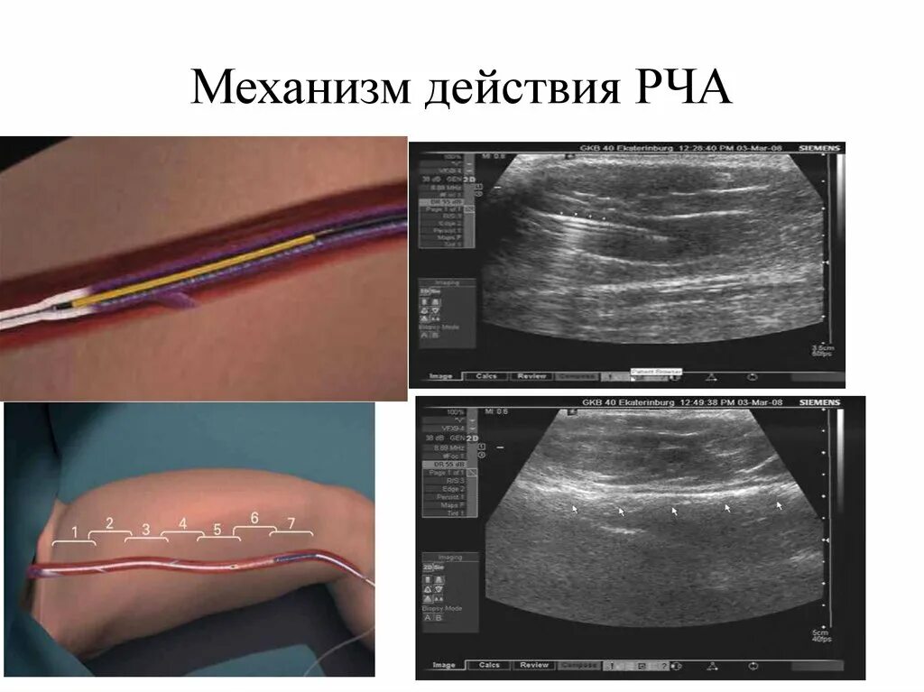 Где делают абляцию. РЧА методика проведения. Радиочастотная катетерная абляция.